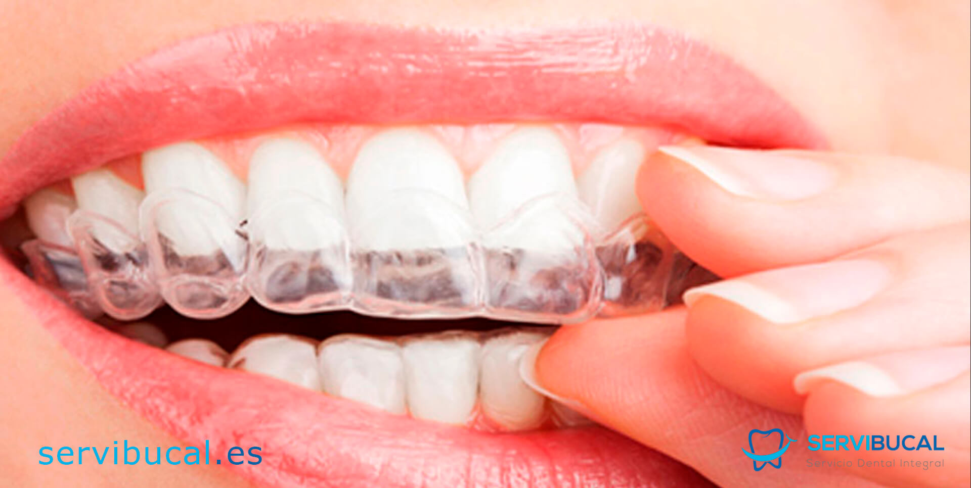 Qué es una férula dental y para qué sirve? - Arteo Estética Dental