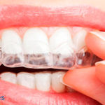 Férulas dentales: Qué son y cuando se usan
