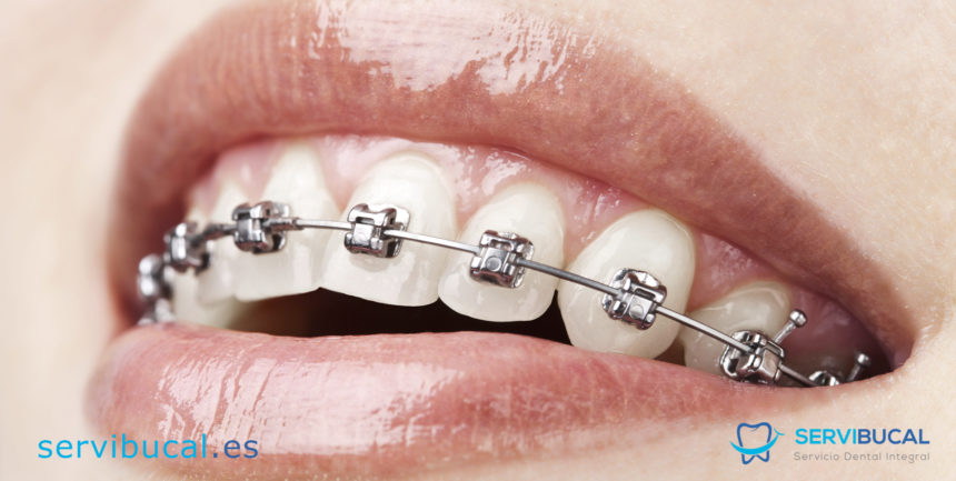 ¿Qué tipos de ortodoncia con brackets existen y para qué se utilizan?