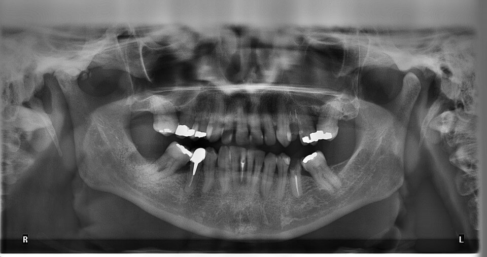 radiografía panorámica dental