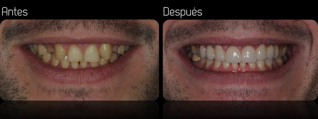 Coronas de porcelana: Ventajas, desventajas y fotos de antes y después