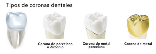 Coronas de porcelana: Ventajas, desventajas y fotos de antes y después