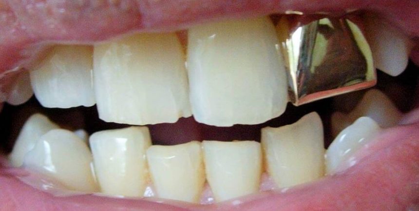 Qué Es Una Corona Dental   Tipos Y Precios De Fundas Dentales