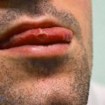 Tipos de infección bucal: Todo sobre las principales lesiones y enfermedades de la boca