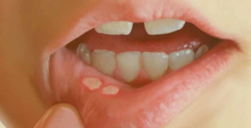 Enfermedades de la boca más comunes