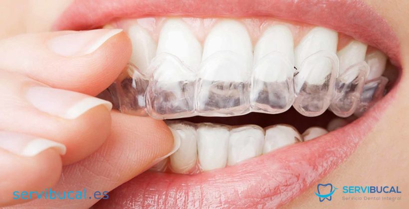 Tipos de retenedores dentales. ¿Qué son y para qué se utilizan? Tipos de retenedores dentales. ¿Qué son y para qué se utilizan?