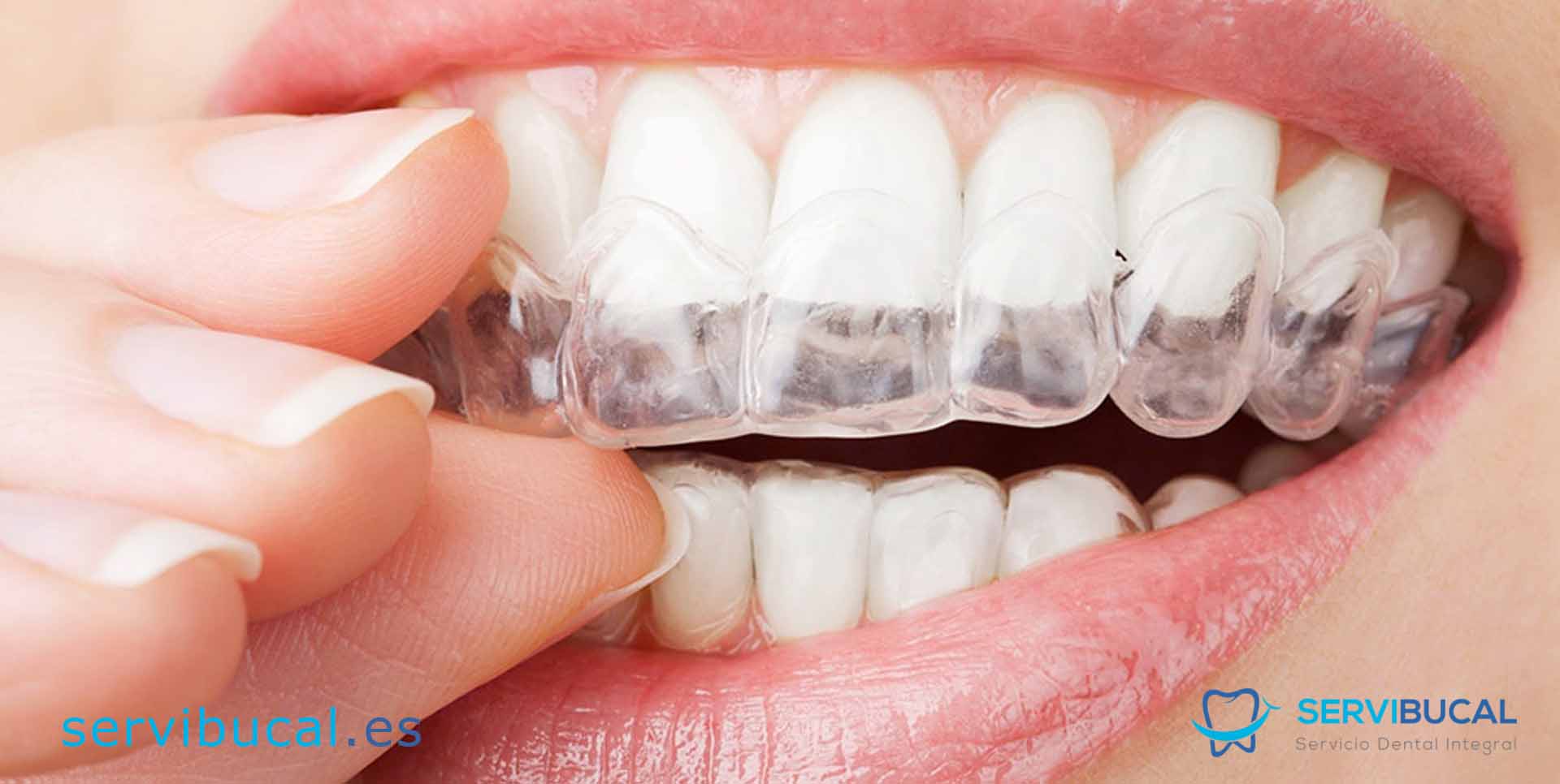 Afirmar Regresa Por Tipos de retenedores dentales , uso y precio de estos