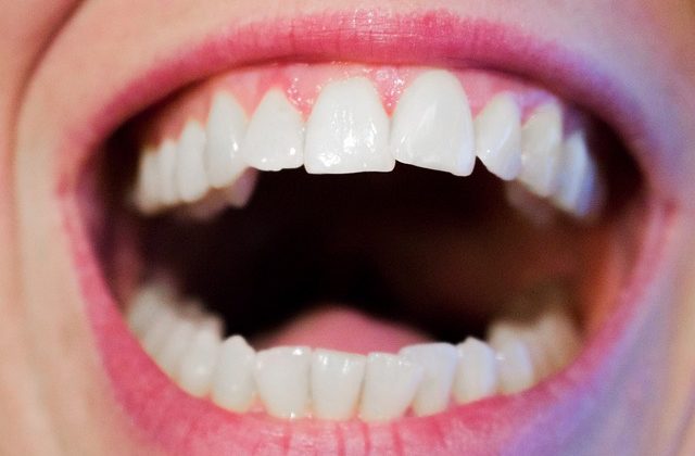 Dientes amarillos y sus causas Dientes amarillos y sus causas