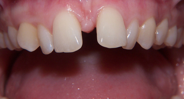 dientes separados