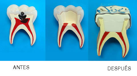 dientes temporales