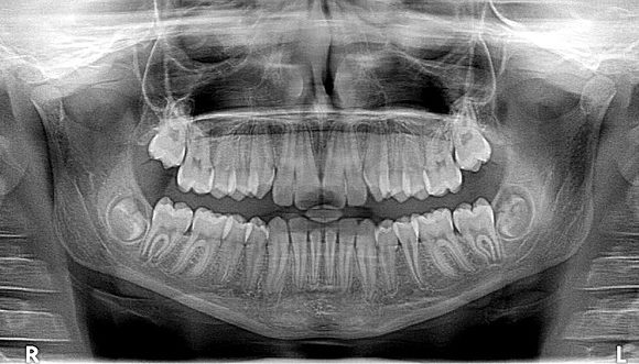 ¿Qué son las radiografías dentales?