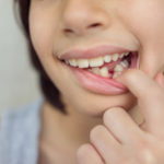 Avulsión dental, ¿qué es y cómo se trata?