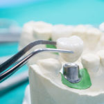¿Cuánto cuesta un implante dental?