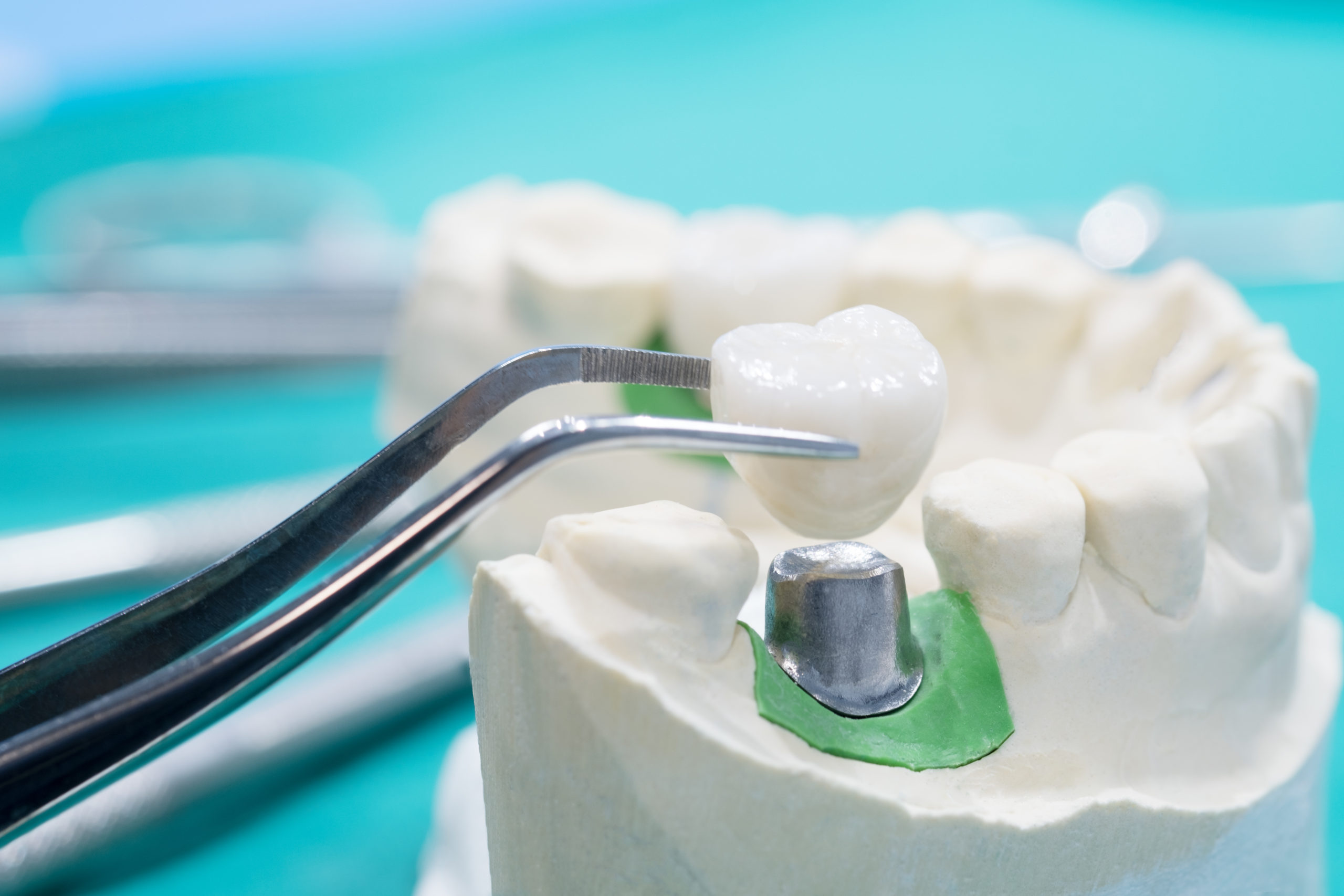 Bóveda Recepción pequeño Cuánto cuesta un implante dental? Tipos de implante dental| Servibucal