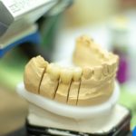Reconstrucción dental. Tipos y cuidados