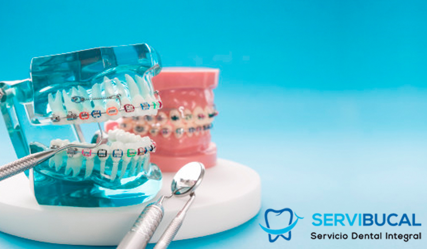 ¿Qué son los brackets autoligables? Servibucal