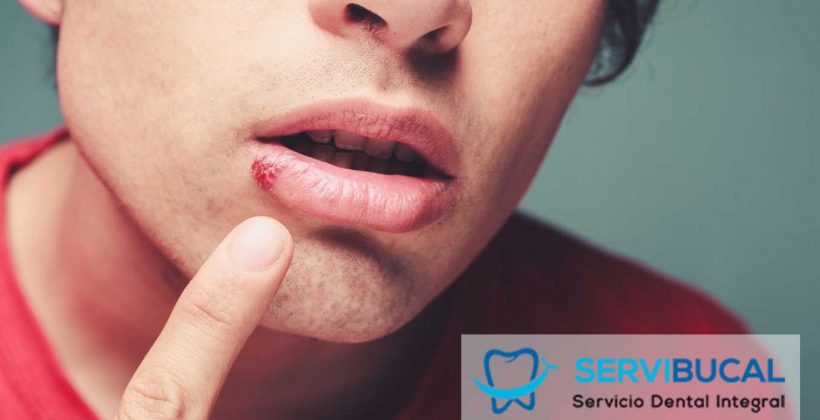 Herpes labial: ¿qué es y cómo se trata? Herpes labial: ¿qué es y cómo se trata?