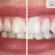 Blanqueamiento dental láser: Ventajas y Resultados