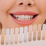 10 motivos por los que se manchan tus dientes
