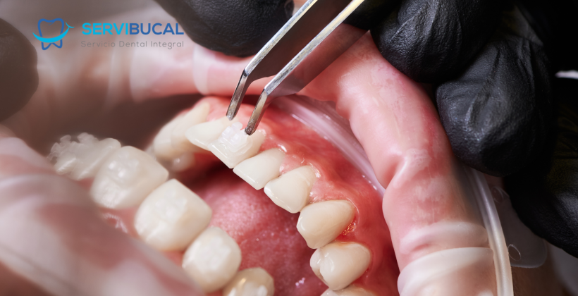 Gingivectomía y gingivoplastia, ¿qué son y cuándo se recomiendan?