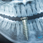 Mucositis periimplantaria: qué es, causas y tratamiento