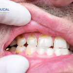 Qué es la hipoplasia dental y cuáles son sus tratamientos