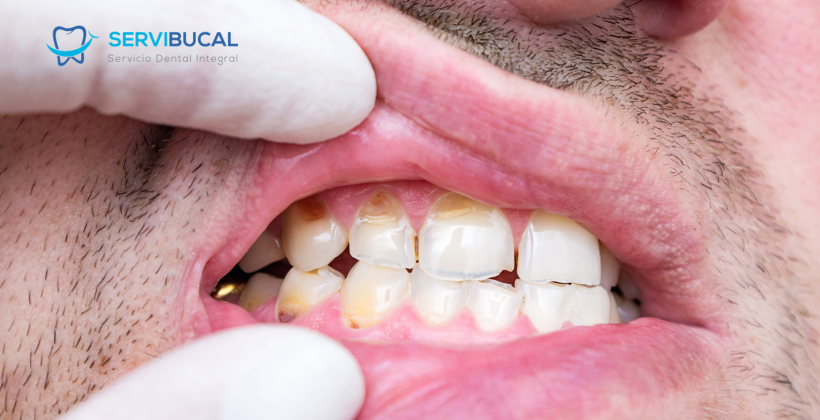 Qué es la hipoplasia dental y cuáles son sus tratamientos Qué es la hipoplasia dental y cuáles son sus tratamientos